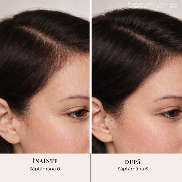Ser Avansat SORAS pentru Regenerarea Scalpului, Reducerea Căderii și Stimularea Creșterii Părului
